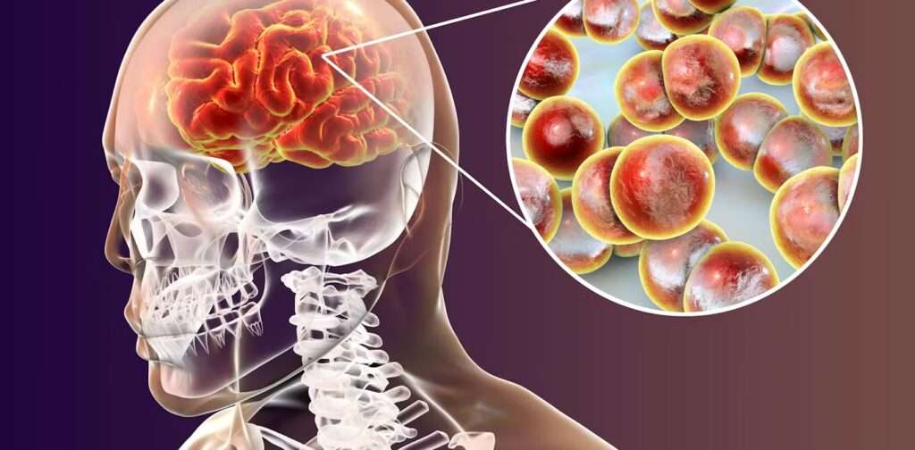 Meningitis neumocócica