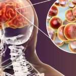 Meningitis neumocócica