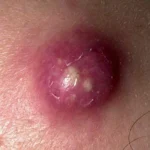 Infecciones por Staphylococcus aureus