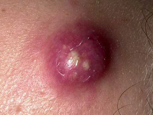 Infecciones por Staphylococcus aureus