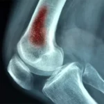 Osteomielitis