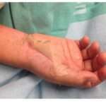 Síndrome de choque tóxico