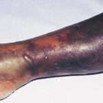 Mionecrosis clostridial (Gangrena gaseosa)