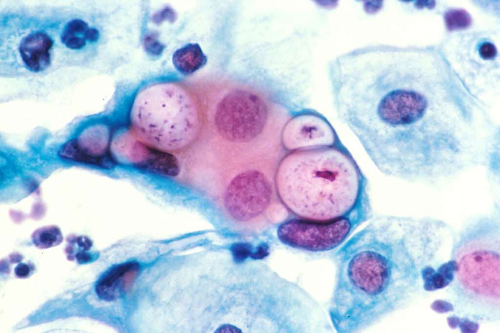 Linfogranuloma Venéreo