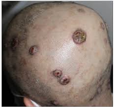 La sífilis terciaria (sífilis sintomática tardía)