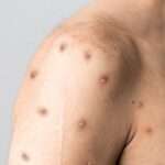 Sífilis en pacientes con infección por VIH