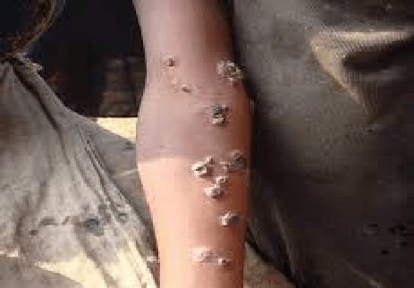 ¿Qué es la frambesía?