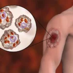 Leishmaniasis