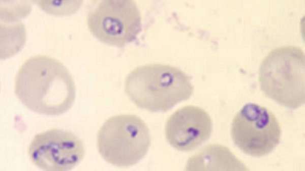 Babesiosis