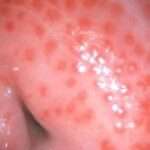 Tricomoniasis