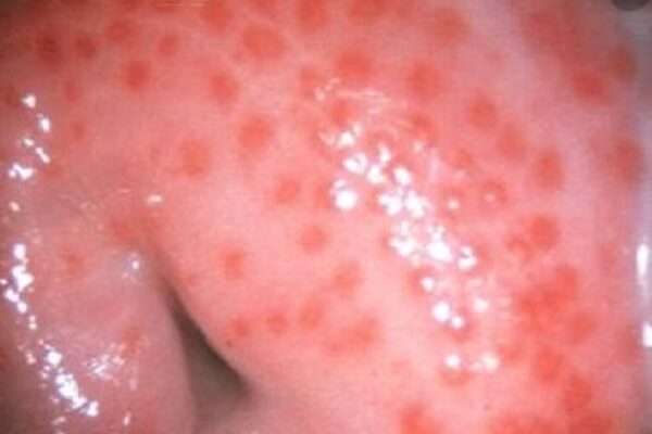 Tricomoniasis
