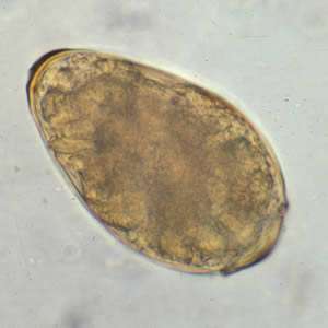 Paragonimiasis