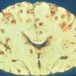 Cisticercosis