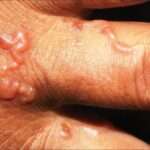 Larva migrans cutánea (Erupción serpiginosa)