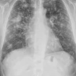 Aspergilosis