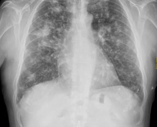 Aspergilosis