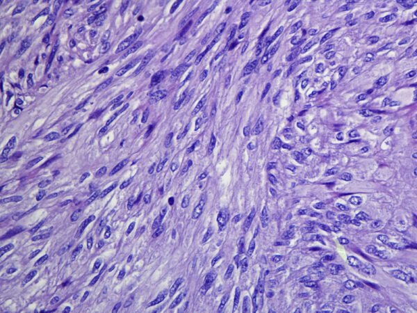 Tumores mesenquimales gastrointestinales