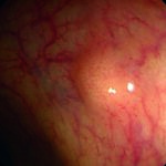 Tumores neuroendocrinos intestinales