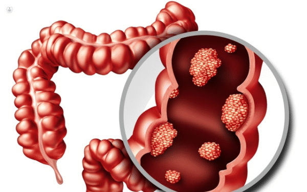 Factores de riesgo para cáncer colorrectal