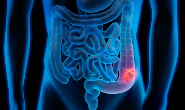 Manifestaciones clínicas del cáncer colorrectal