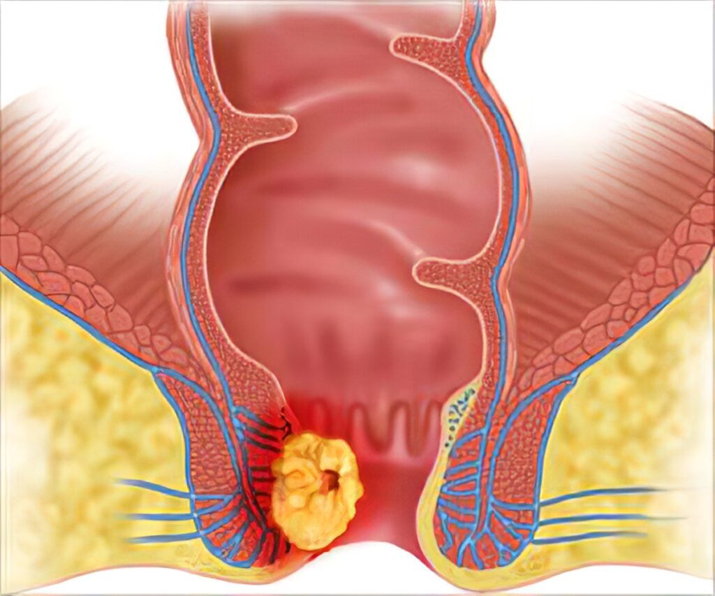 Carcinoma del ano