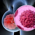 Cánceres secundarios del testículo