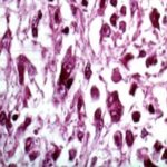 Enfermedad de Gaucher