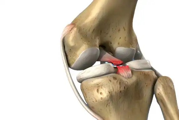 Lesión del ligamento cruzado posterior