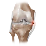 Lesión del ligamento colateral de la rodilla