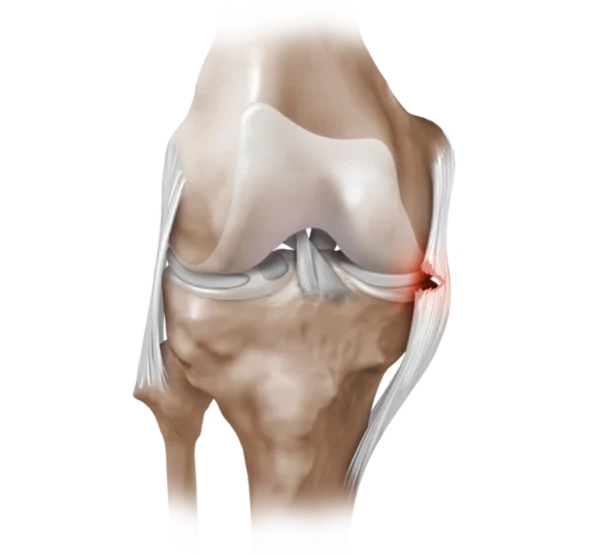 Lesión del ligamento colateral de la rodilla