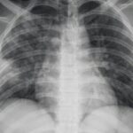 Valoración radiológica de las enfermedades pulmonares