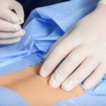 Bloqueos para cirugía de abdomen