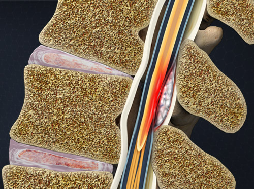 Complicaciones infecciosas de la anestesia regional