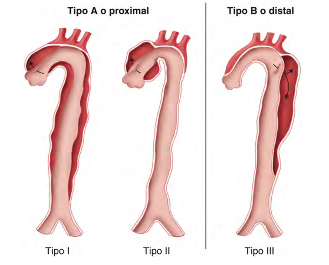 Clasificación: Hematoma intramural y disección aórticos Clasificación: Hematoma intramural y disección aórticos