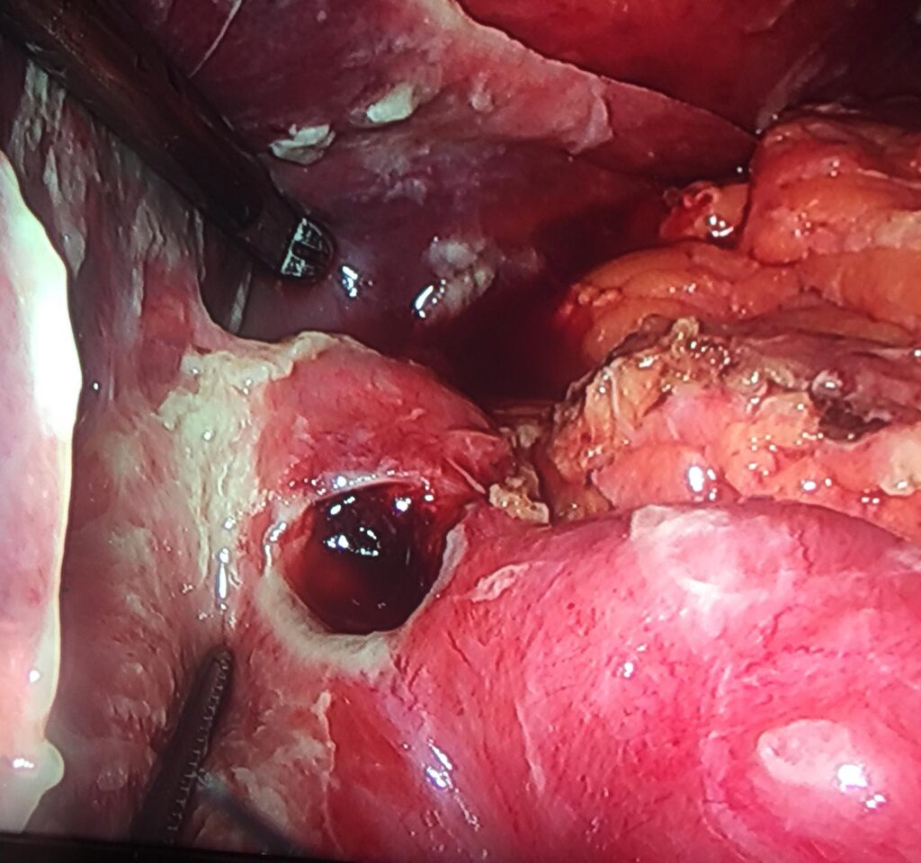 Manejo quirúrgico de la perforación gastroduodenal
