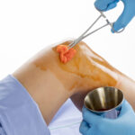 Antisepsia