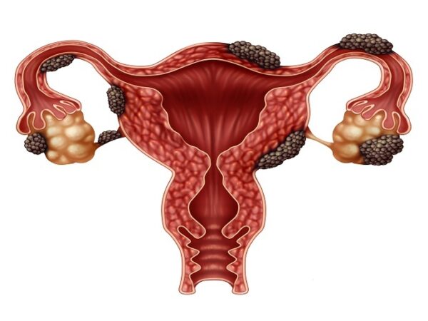 Bases fisiopatológicas del manejo de endometriosis