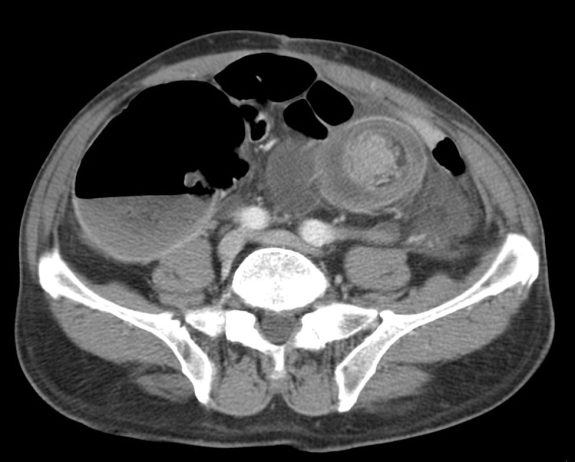 Obstrucción intestinal. Signos radiológicos.
