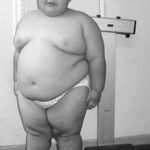 Tratamiento del Síndrome de Prader-Willi con hormona de crecimiento