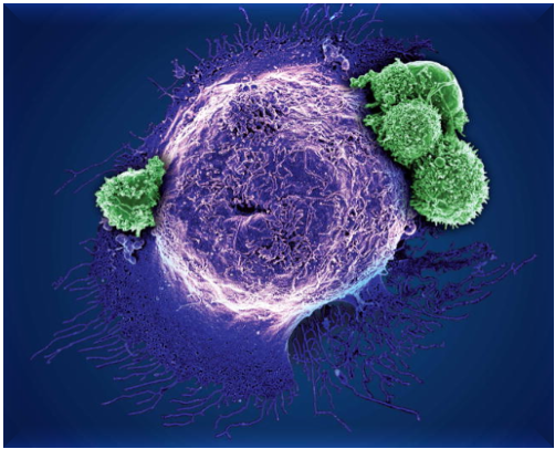 Terapia celular con receptores de antígeno quimérico