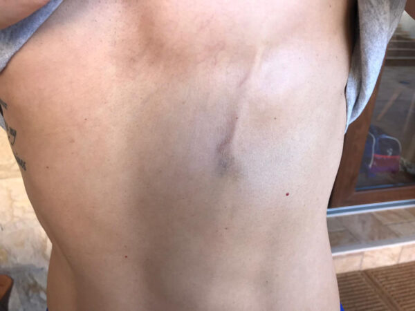 Enfermedad de Mondor