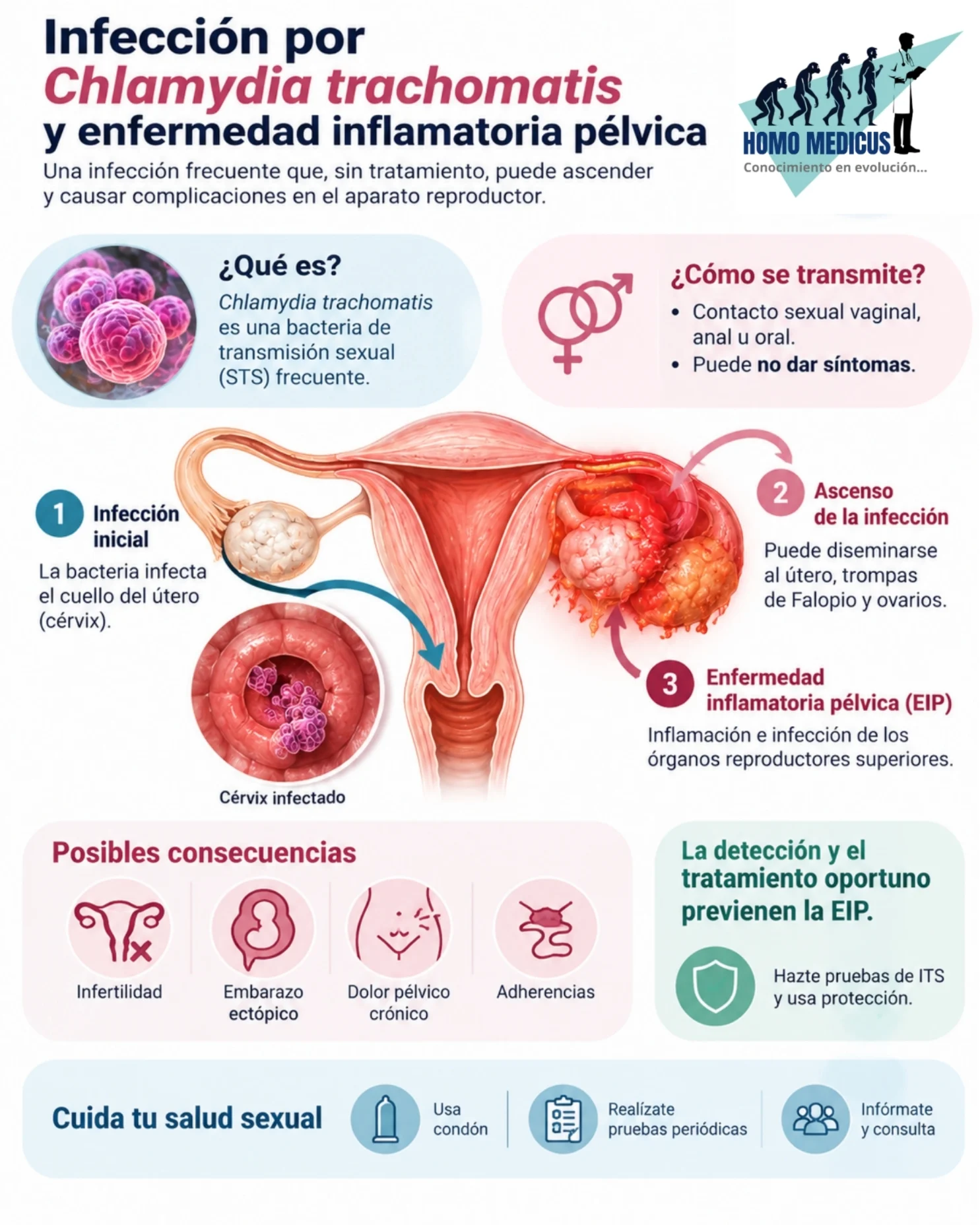 Infección por Chlamydia trachomatis y desarrollo de enfermedad inflamatoria pélvica